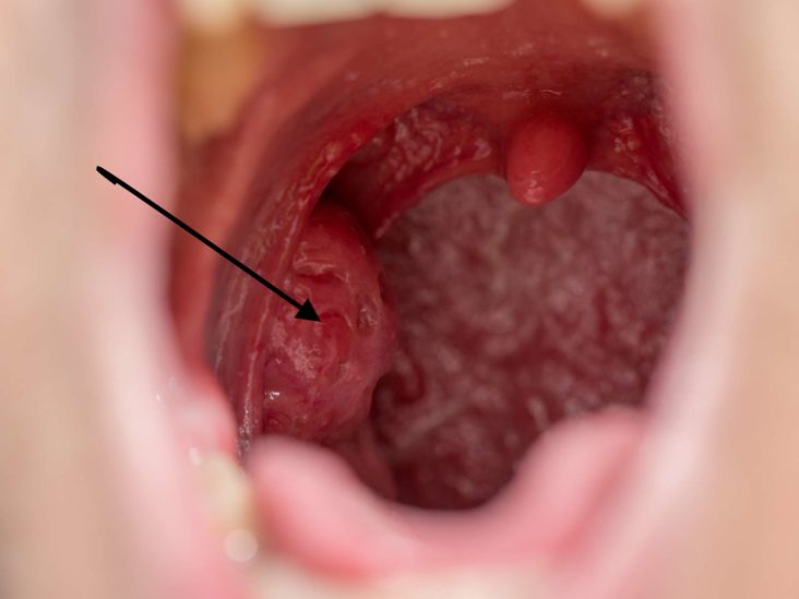 Tonsils