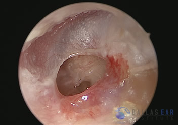Traumatic Ear Perforation