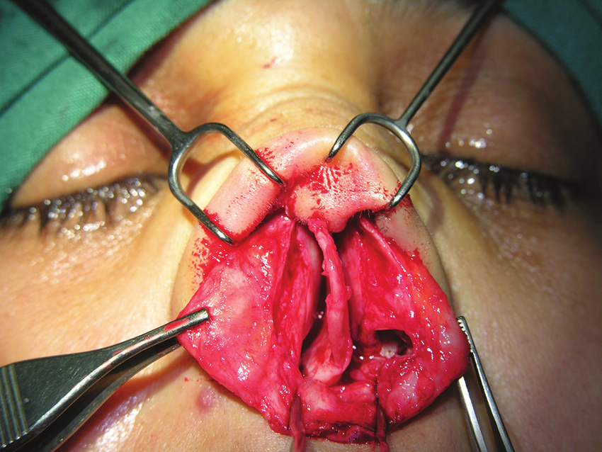 Septorhinoplasty